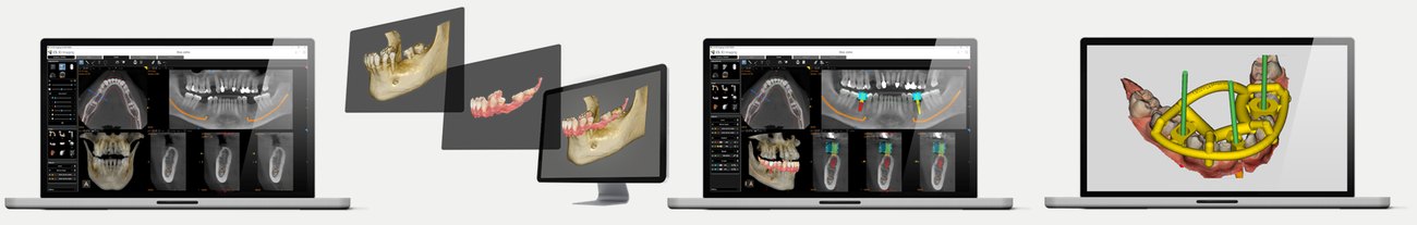 Carestream 3D Imaging Premium: CBCT előkészítés, CBCT-IOS egyesítés, PDIP, sebészeti sablon terv